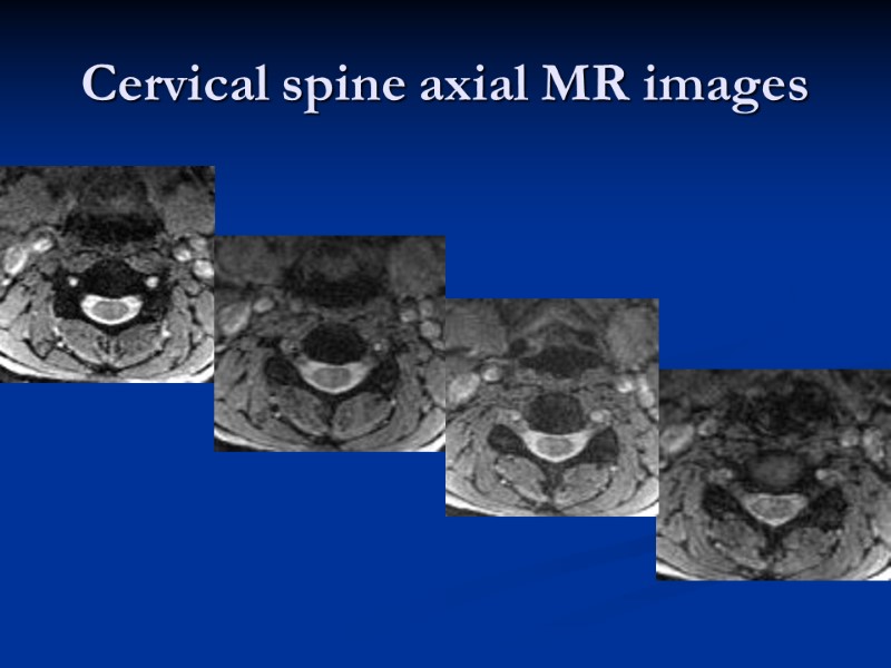 Cervical spine axial MR images